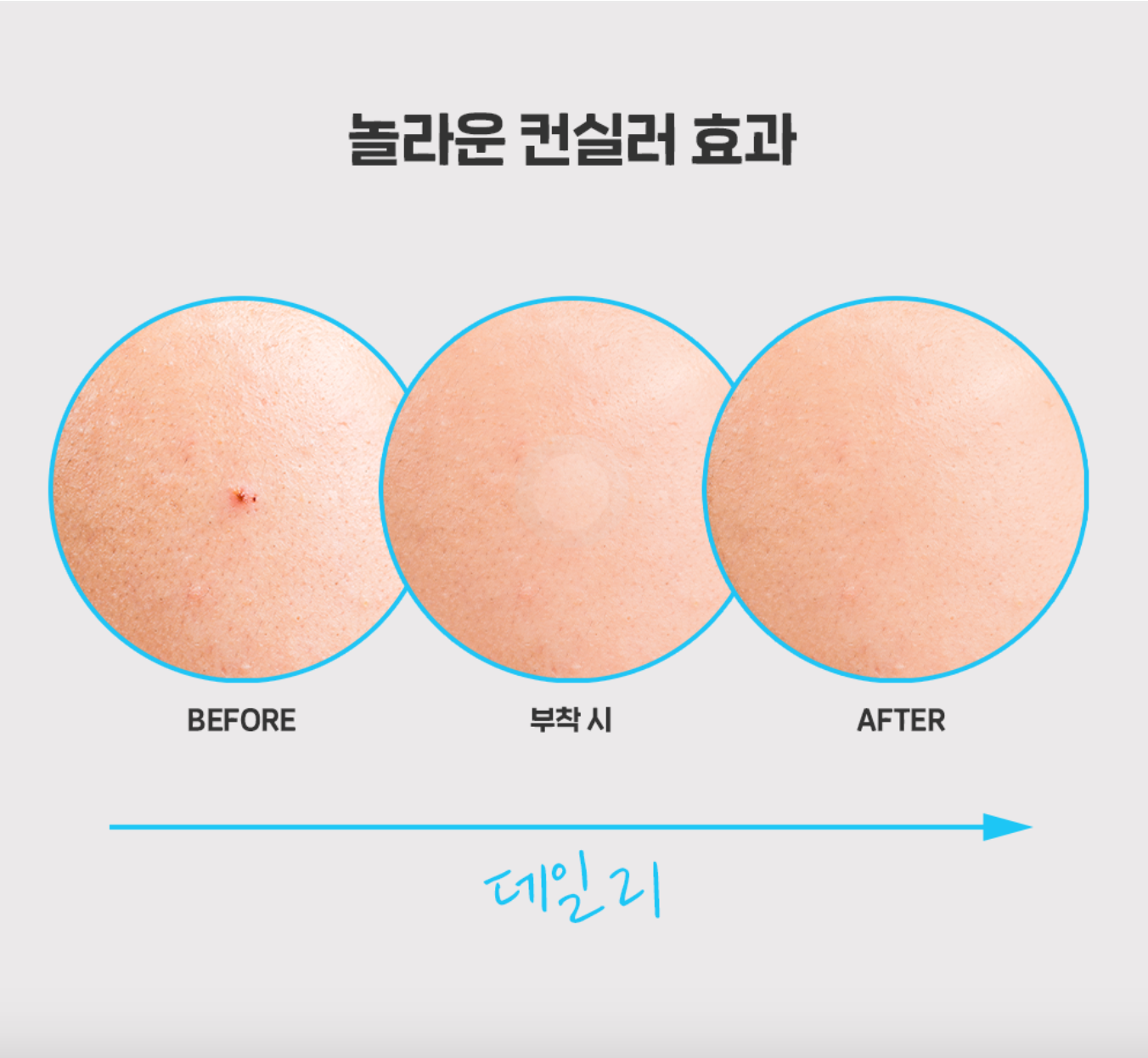 SPOT ERASER BLUE 63 PARCHES - NOLAHOUR